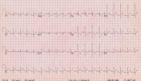 Paediatric ECG Interpretation • LITFL • ECG Library Basics Brugada Syndrome, Bundle Branch Block, Atrial Septal Defect, Ecg Interpretation, Degenerative Disease, Acute Care, Emergency Medicine, Assessment Tools, Self Assessment