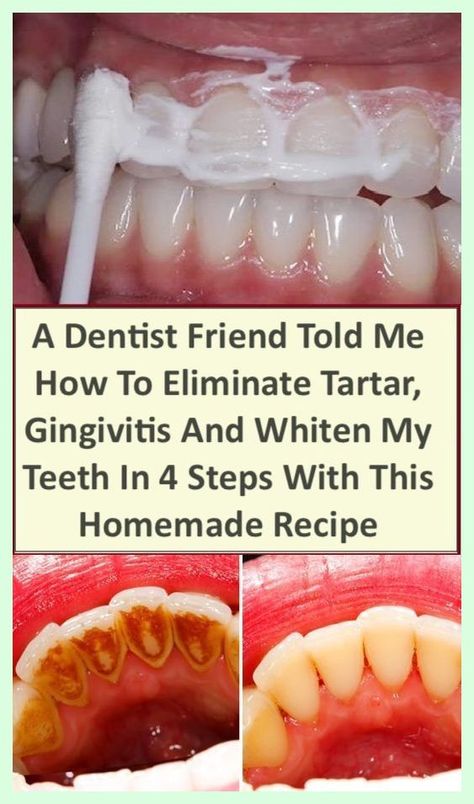 If you ever need anything… Exquisite information! Cooking With Turmeric, Veneers Teeth, Receding Gums, Diy Remedies, Homemade Recipe, Natural Therapy, Personal Health, Tooth Decay, Natural Home Remedies