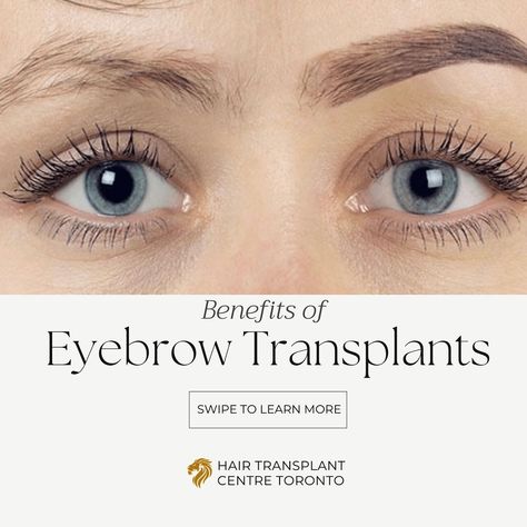 Eyebrow transplants! This innovative procedure offers a range of benefits that can truly transform your look and confidence. Swipe through to discover more! Elevate your brow game with eyebrows that frame your face perfectly. Contact us today: 📞 (416) 861-8600 📧 info@hairtransplantto.com 📍 100 King St W, Toronto, ON #eyebrowtransplant #fuehairtransplant #futhairtransplant #hairtransformation #hairlosstreatment #hairlosssolutions #hairtransplants Eyebrow Transplant, Fue Hair Transplant, Hair Transplant, Hair Transformation, Eyebrows, Toronto, Benefits, Confidence, Range