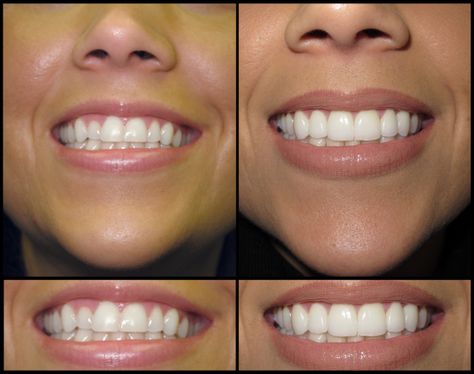 Natural Looking Veneers Teeth, Porcelain Veneers Before And After, Veneers Before And After, Perfect Teeth Smile, Natural Veneers, Natural Teeth Whitening Remedies, Pretty Teeth, Dental Aesthetics, Dental Work