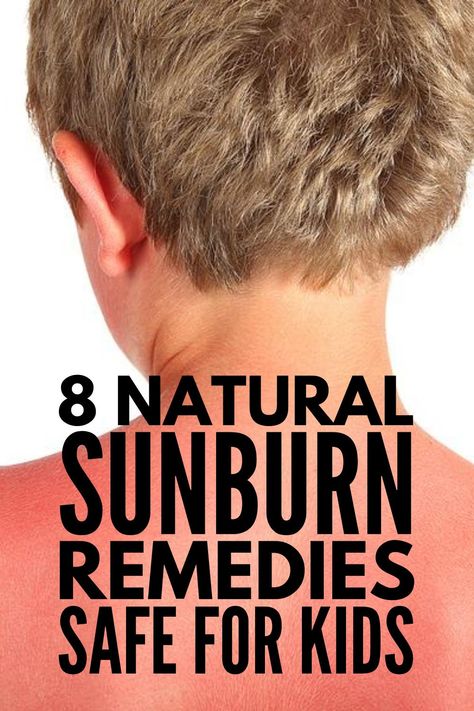 8 Sunburn Remedies for Quick Relief | If you're looking for the best natural at home remedies for a sunburn, these ideas offer fast relief - they cool and soothe your skin while also relieving pain and discomfort. You should seek medical attention for a severe and blistered sunburn, but these natural remedies are great for taking the sting out of mild sunburns. These DIY remedies use products you have at home, like Aloe Vera, witch hazel, coconut oil, and tea, and they are safe for kids! Children Fever Remedies, Cough Remedies For Kids, Home Remedies For Sunburn, Get Rid Of Sunburn, Severe Sunburn, Aloe Vera For Sunburn, Remedies For Dry Mouth, Natural Remedies For Sunburn, Home Remedies For Allergies