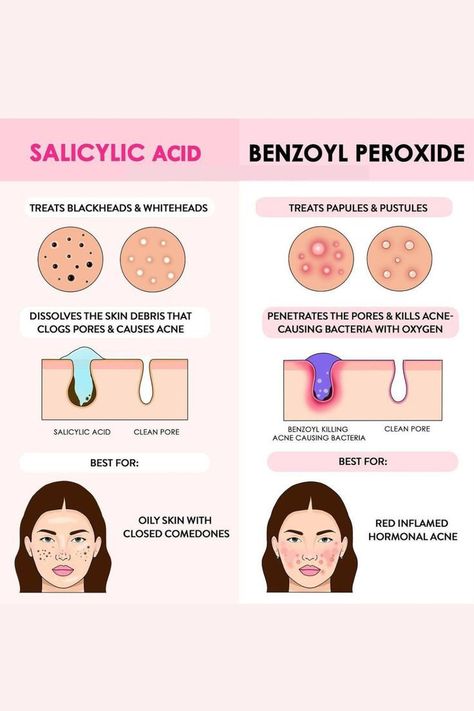 Salicylic Acid Benefits, Acne Types, Back Acne, Natural Acne, Types Of Acne, Skin Science, Skin Detox, Hormonal Acne, Acne Solutions