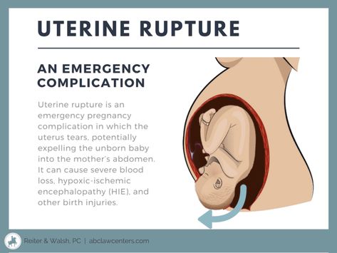 uterine rupture - Ecosia - Images Obstetrics Nursing, Medical Negligence, Midwifery Student, Nursing Classes, Child Nursing, Student Midwife, Nursing School Essential, Nursing Study Guide, Nursing Mnemonics