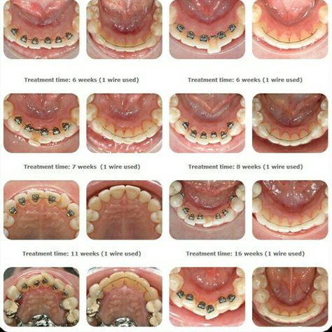 Braces Journey, Braces Before And After, Lingual Braces, Straight Smile, Invisible Braces, Dental Photography, Brace Face, Braces Colors, Dental Braces