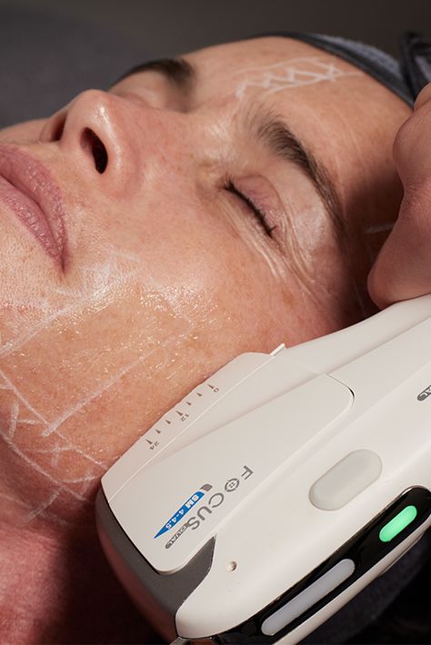 Hifu Facial, Ultrasound Skin Tightening, Ultrasound Facial, Facial Aesthetic, Radio Frequency Skin Tightening, Skin Tightening Treatments, Face Mapping, Botox Injections, Radio Frequency