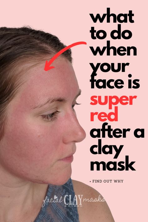 Is Redness after a clay mask normal?  Redness after using a powerful clay mask is normal. It should not get painful and improve within half an hour. This draws blood to the surface of skin and provide oxygen and nutrients. Indian Healing Clay Benefits, Red Clay Mask, Redness Face, Aztec Clay Mask, Clay Recipes, Aztec Clay, Bentonite Clay Mask, Congested Skin, Routine Tips