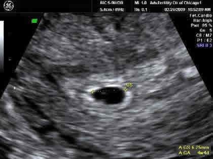 Normal pregnancy ultrasound at 5 weeks gestation Usg Pregnancy 3 Weeks, 2 Weeks Pregnant Ultrasound, 4 Week Ultrasound, 6 Week Ultrasound Pictures, 3 Weeks Pregnant Ultrasound, 5 Week Ultrasound Pictures, 8 Weeks Pregnant Ultrasound, 4 Weeks Pregnant Ultrasound, 7 Weeks Pregnant Ultrasound