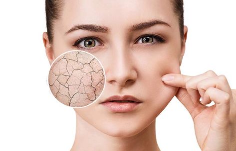 Dehydrated Skin: Causes, Symptoms, And How To Care For It Facial For Dry Skin, Peeling Facial, Dry Skincare, Dry Skin Problem, Dry Skin Care Routine, Scaly Skin, Winter Skin, Dry Skin Care, Flaky Skin