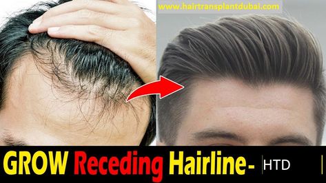 How to Grow Back Your Hairline Naturally? Regrow Hairline, Mens Hair Regrowth, Grow Hair Back, Receding Hair Styles, Natural Hair Regrowth, Regrow Hair, Bad Haircut, Hair Growth Faster, Lost Hair