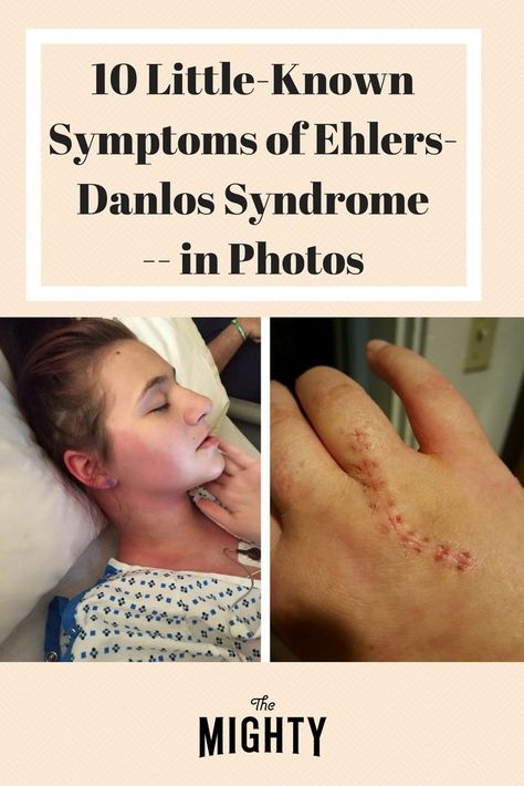 10 Photos of Little-Known Symptoms of Ehlers-Danlos Syndrome | The Mighty #ehlersdanlossyndrome #zebras #zebrastrong #edszebra #chronicillness #chronicpain #chroniclife #chronicwarrior #photography Ehlers Danlos Syndrome Symptoms, Elhers Danlos Syndrome, Ehlers Danlos Syndrome Hypermobility, Ehlers Danlos Syndrome Awareness, Mast Cell Activation Syndrome, Ehlers Danlos, Ehlers Danlos Syndrome, Rare Disease, Invisible Illness