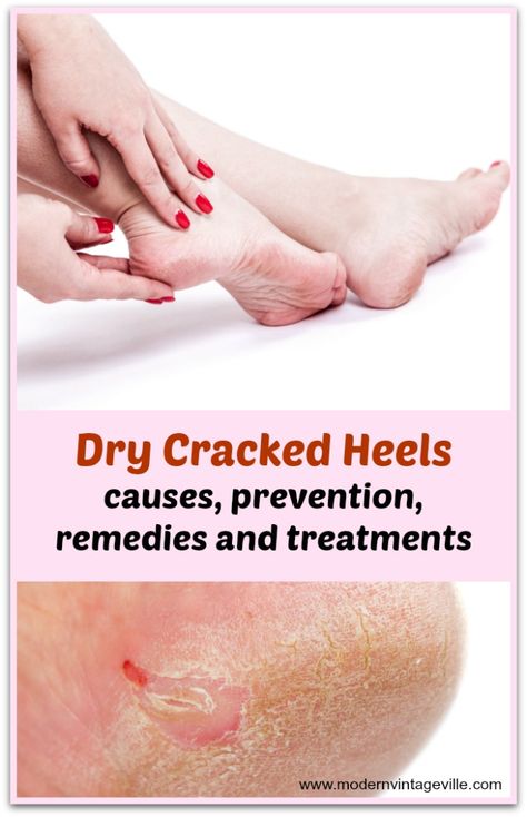 Many women are searching for a way to get rid of cracked painful heels. You can easily do it at home with 80% lactic acid (easily available on amazon). Dead, dry and hard skin literally peels off your heels leaving them smooth and soft. How To Get Smooth Heels, Dry Heels How To Get Rid Of, Remedies For Cracked Heels, What Causes Warts, Heels Tips, The Best Skin Care Routine, Plantar Warts, Natural Remedies For Cold, Warts On Hands