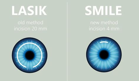 Are you facing problems finding the best hospital for lasik eye surgery in dehli? Don't worry we got you covered! Read More to know what precautions you need to consider before going for smile lasik eye surgery. Know wht are the most advanced ways to minimize the precautions that might occur in smile eye surgery. Lasik Eye Surgery, Laser Eye Surgery, Lasik Surgery, In Smile, Laser Eye, Doctors Note, Eye Surgery, Best Hospitals, Hair Removal Cream