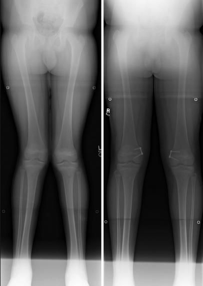 Genu Valgum (knocked knees) - Pediatrics - Orthobullets Knocked Knees, Genu Valgum, Knock Knees, Human Body Anatomy, Body Anatomy, Online Community, Pediatrics, Anatomy, Human Body