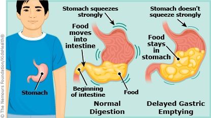 Gastroparesis (Delayed Gastric Emptying), KidsHealth Delayed Gastric Emptying Diet, Easily Digested Foods, 2000 Food, Dumping Syndrome, Ibs C, Low Oxalate Diet, Oxalate Diet, Gastric Problem, Low Oxalate