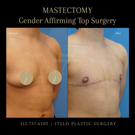 Gender affirming surgery is an important step for many people as they achieve their desired body image. This patient had Dr. Iteld perform a complete mastectomy as part of his transition to male. Interested in exploring changing the physical characteristics of your face or body to more closely match your identity? Schedule your confidential consultation with us: 312.757.4505. #beforeandafter #mastectomy #genderaffirming #transgendersurgery #transgender #plasticsurgery #chicagoplasticsurgeon Plus Size Top Surgery, Top Surgery Results, Goat Man, Gender Euphoria, Gender Affirming, Desired Body, Top Surgery, Physical Characteristics, Before After Photo