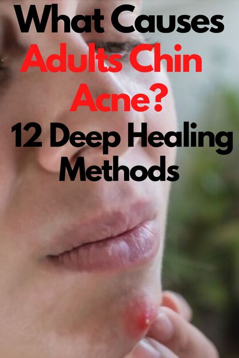 What Causes Adults Chin  Acne? 12 Deep Healing Methods Chin Breakout Causes, Acne Is Normal, Breaking Out On Chin, Chin Acne Remedies, Chin Breakouts, Chin Acne Causes, Acne Cover Up, Cystic Acne On Chin, Nodule Acne