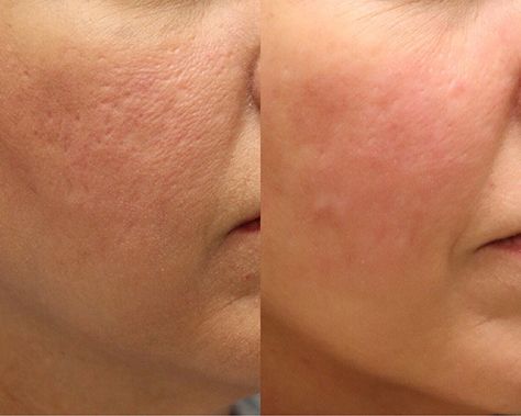 Microneedling Before And After, Microneedling Aesthetic, Laser & Ipl Hair Removal Devices, Skin Care Pictures, Acne Scarring, Facial Aesthetics, Eye Liner Tricks, Ipl Hair Removal, Dream Career