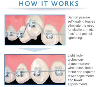 Great features of self ligating!! Light Blue Braces Teeth, Lightforce Braces, Self Ligating Braces, Damon Braces, Orthodontic Shirts Braces, Dental Office Marketing, Types Of Braces, Kids Braces, Traditional Braces