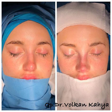 Nose Job From Front View, Button Nose Front Profile, Rhinoplasty Front View, Button Nose Front View, Nose Job Front View, Different Nose Types, Bulbous Nose Rhinoplasty Before After, Wide Nose Rhinoplasty, Nose Goals