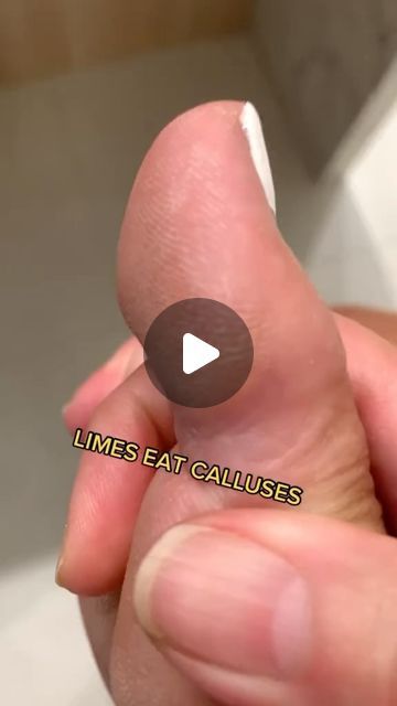 Anne Caserta on Instagram: "#feet #Pedicures" How To Get Rid Of Calluses On Feet Fast, Feet Pedicure, Callus Remover Diy, Peppermint Sugar Scrubs, Diy Medicine, Foot Pedicure, Callus Removal, Natural Health Remedies, Diy Natural Products