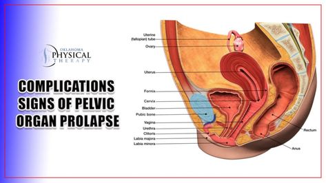 Symptoms and Treatments of Pelvic Organ Prolapse – Comprehensive Guide Plan - Oklahoma Physical Therapy #calories #therapistokc #prostatitisdiet #dyspareuniatreatment #wooninja #prostatitissymptoms #ui oklahoma #keagels #prostatitistreatments #bppvmedication #oklahomasilhouette #arnoldkegel #habituationexercises #vestibularphysiotherapy #spineosteoarthritis #arnold kegel #physicaltherapistnearme Prolapsed Uterus Symptoms, Prolapsed Uterus, Pelvic Muscles, Uterine Prolapse, Pelvic Floor Therapy, Pelvic Organ Prolapse, Stomach Muscles, Fallopian Tubes, Diastasis Recti