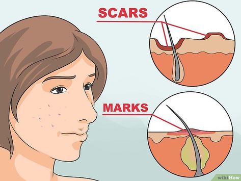 2 Easy Ways to Get Rid of Red Acne Marks (with Pictures) Red Acne Marks, How To Do Eyeshadow, Scar Remedies, Cystic Acne Remedies, Steaming Your Face, Dark Spots On Face, Natural Acne Remedies, Acne Scar Removal, Spots On Face