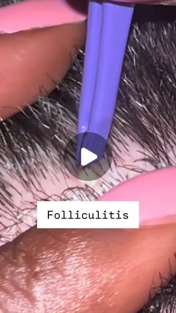 Dr. David Kim on Instagram: "Skincare recommendations for folliculitis! Folliculitis is inflammation of the hair follicles and it most commonly affects athletes and people who sweat a lot but it happens to everyone. These are 3 simple ways to manage it.👨🏻‍⚕️

✅ Shampoo. You’ve got to wash your hair any time you wear hair spray/ gel, minoxidil or other topical products. Accumulation of products can irritate your scalp and cause inflammation. Use @nizoralofficial with 1% ketoconazole 2-3x per week. 

✅ Hibiclens. This anti-microbial solution is magic. Use this in the shower 2-3x per week and leave it on for 30s before you wash it off. 

✅ Panoxyl. Use Panoxyl w/ 10% Benzoyl Peroxide as a hair mask on the nights you don’t use hibiclens. Leave it on for 30s-1 min and wash it off w/ shampoo. Hibiclens Uses, Infected Hair Follicle, Skincare Recommendations, Skin Hacks, Health And Self Care, Instagram Skincare, Benzoyl Peroxide, Hair Raising, The Nights