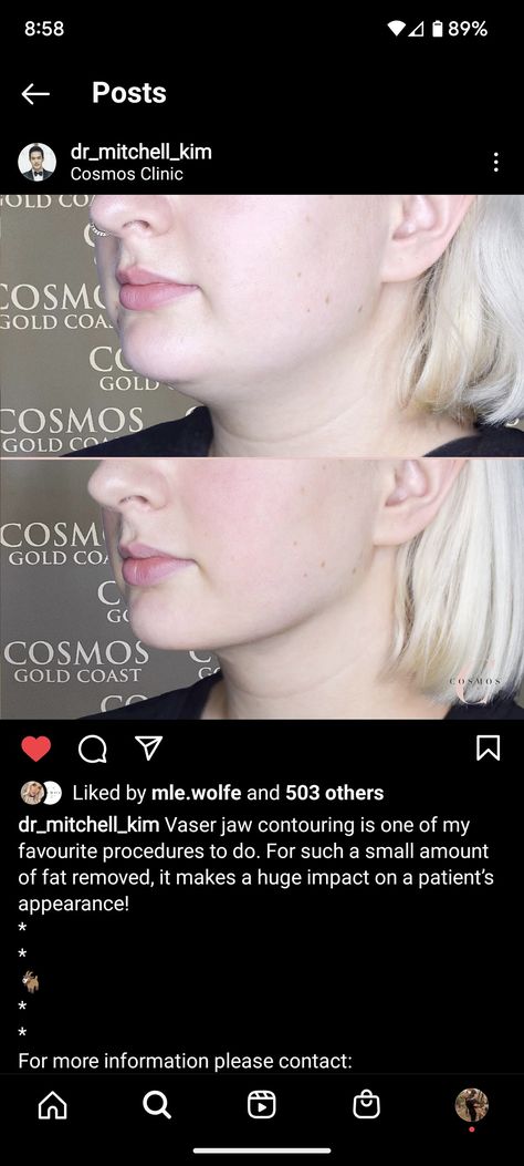 Vaser Lipo Before And After, Neck Lipo Before And After, Chin Lipo Before And After, Vaser Lipo, Lipo Before And After, Chin Filler, Face Fillers, Botox Filler, Body Details