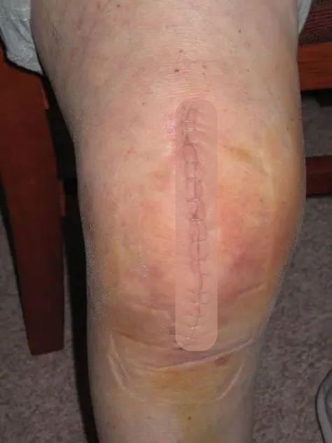 Sleeping After Knee Replacement, Bone On Bone Knee Pain Relief, How To Tape Knee For Pain, Knee Cartilage Repair, Knee Replacement Recovery Tips, Full Knee Replacement, Physio Tips, Knee Replacement Pain, Exercises For Arthritic Knees