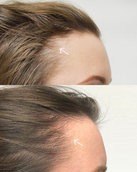 HD-PRP   Results shown after 6 weeks  PRP has become a mainstay for slowing hair loss and growing new hair for both men and women, but High Density (HD) PRP has become the new standard thanks to Dr. Welter and the pioneering research of the Regeneris team.   #photofacial #bostonlaser ⁠#botoxboston #fillersboston #lipfiller #medspa #wrinkles #neckwrinkles #hairlosswomen #hairlosstreatment #hairlosssolutions #hairloss Nails Pink Ombre, Prp For Hair, Glossy Acrylic Nails, Acrylic Nails Cute, Prp Hair, Biotin Hair Growth, Biotin Hair, Beauty Video Ideas, Skin Aesthetics