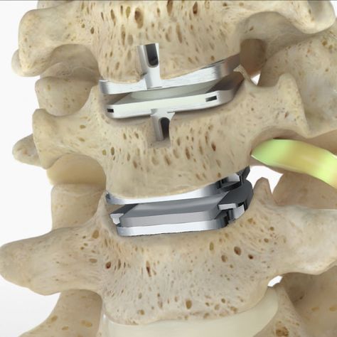 Dish Spine Disease, Disk Degenerative Disease, Degenerative Disk In Lower Back, Degenerative Disk In Neck, Degenerative Lumbar Disc Disease, Degenerating Disc Disease, Cervical Disc, Lumbar Disc, Study Site