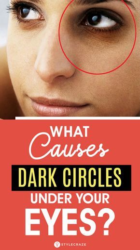 What Causes Dark Circles Under Your Eyes? If you thought lack of sleep is the reason for your dark circles, you could be right. But did you know there are many other causes of this problem? In this post, we have discussed all the possible causes of dark circles. Take a look. #darkcircles #SkinCare #Causes #Health #Wellness Dark Rings Under Eyes, Causes Of Dark Circles, Best Under Eye Cream, Baggy Eyes, Dark Circles Around Eyes, Dark Rings, Dark Eye Circles, Aloe Vera Face Mask, Remove Dark Circles