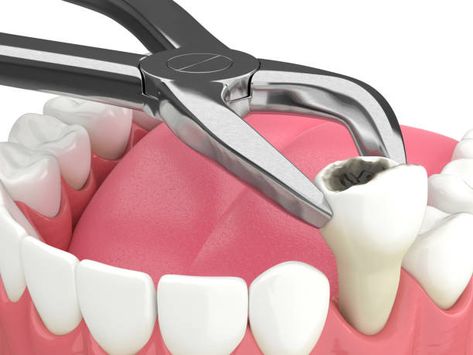 Otherwise known as caries or tooth decay, a cavity is a hole in the tooth. It is an opening on the hard surface of the tooth enamel that constantly expends unless it is treated. There are many reasons why cavities develop. Usually, it is a lack of dental hygiene. Dental Extraction, Tooth Pulled, Wisdom Tooth Extraction, Wisdom Teeth Removal, Tooth Removal, Teeth Implants, Tooth Extraction, Dental Procedures, Wisdom Teeth