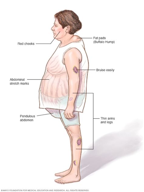 Cushing syndrome - Symptoms and causes - Mayo Clinic Pituitary Gland Disorders, Pituitary Gland Tumor, Cortisol Diet, Cushing Syndrome, Cushing’s Syndrome, Adrenal Fatigue Symptoms, Cushings Syndrome, Reducing Cortisol Levels, Endocrine Disorders