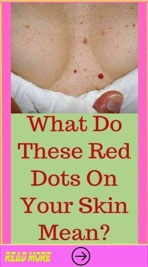 What Do These Red Dots On Your Skin Mean? Red Skin Spots, Blind Pimple, Emotional Eater, Skip Breakfast, Pants Outfit Fall, Losing 40 Pounds, Cold Medicine, Skin Natural Remedies, Diy Skin Care Recipes