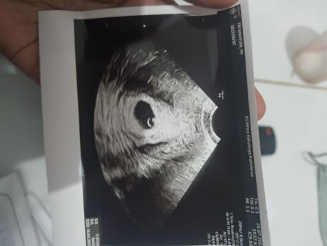 cek ke dokter dan pas periksa udah keliatan kantong kehamilan, alhamdulillah.. Hasil Usg Kandungan, Usg Kehamilan, Ultrasound Student, Twins Ultrasound, Elon Musk Biography, Fake Home, Fake Pregnancy, Pregnancy Ultrasound, Unique Baby Boy Names