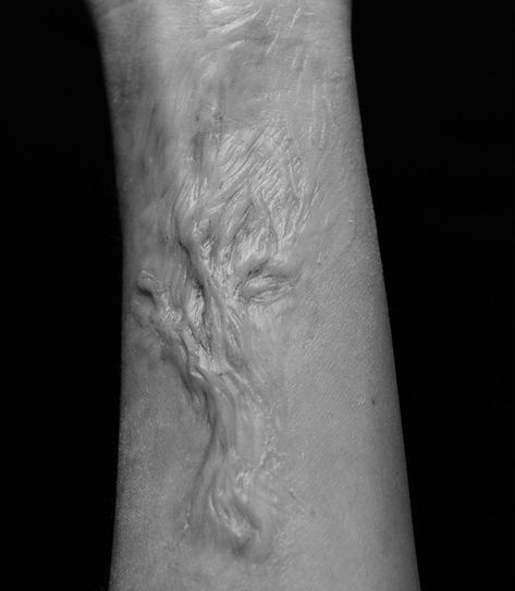 Healed Burn Scar Reference Drawing, Burned Skin Aesthetic, Chemical Burn Scar Reference, Track Marks On Arm, Scars On Dark Skin Reference, Infected Aesthetic, Burn Scar Reference Drawing, Scar Aesthetic, Face Burn