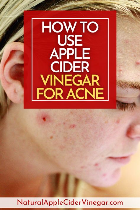 If your wondering how to use apple cider vinegar for acne check out this article. Check out this article to find natural home remedies for how to use apple cider vinegar for acne. This article will tell you how to use apple cider vinegar for acne. Use this home remedy for how to use apple cider vinegar for acne. #applecidervinegar #acneremedy #skincare #homeremedy Applecidervinegar Benefits For Skin, Apple Cider Vinegar Uses For Skin, Apple Cider Vinegar Face Wash Recipe, Apple Cider Vinegar Benefits For Skin, Apple Cider Vinegar On Face, Applecidervinegar Benefits, Apple Cider Vinegar For Face, Acv For Acne, Apple Cider Vinegar For Acne