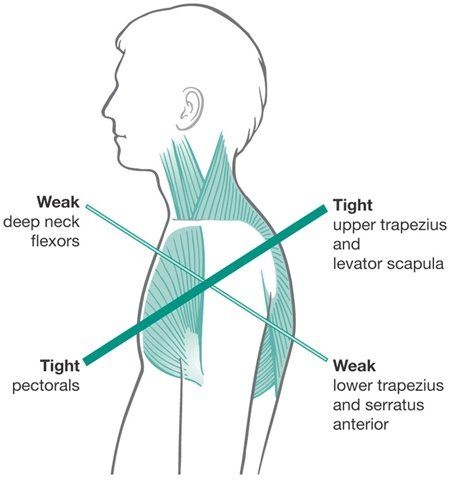 Scapula Exercises, Upper Cross Syndrome, Fix Rounded Shoulders, Posture Fix, Shoulder Impingement, Bolesti Chrbta, Pelvic Floor Dysfunction, Posture Exercises, Muscle Anatomy