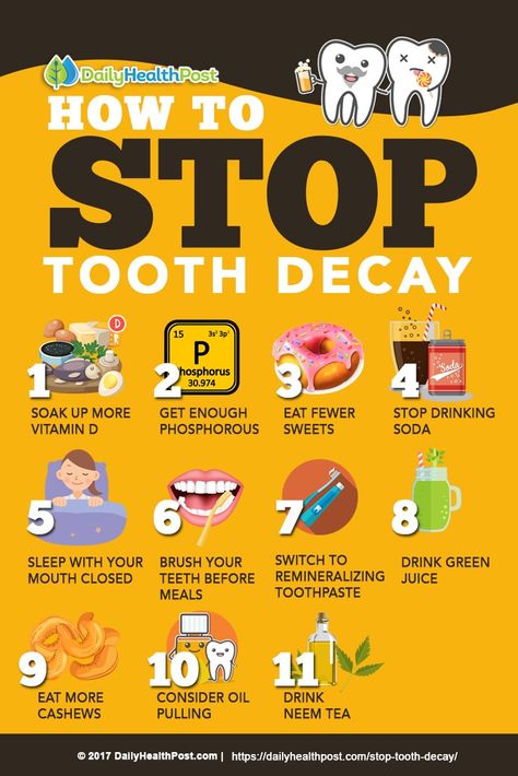 How to Stop Tooth Decay with These 11 Tooth-Healthy Habits  #dailyhealthpost Natural Remedies For Cavities, Wisdom Teeth Swelling, Tooth Extraction Aftercare, Tooth Extraction Healing, Dental Posts, Dental Cavities, Oral Surgeon, Health Post, Tooth Sensitivity