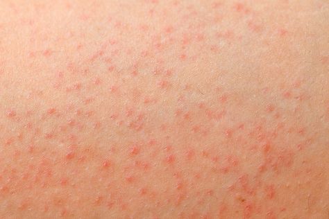 Red Dots On Legs Skin, Red Rashes On Skin, Skin Rashes Pictures Types Of, Skin Rashes Pictures, Rash On Back, Allergic Reaction Rash, Types Of Skin Rashes, Leg Rash, Itchy Skin Rash