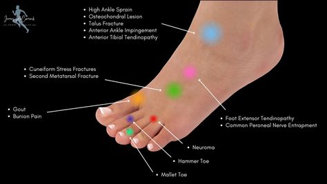 Calcaneus Fracture, Foot Pain Chart, Lisfranc Injury, Achilles Tendinopathy, Pain Chart, Ligament Injury, Ankle Pain, Tooth Pain, Sprained Ankle