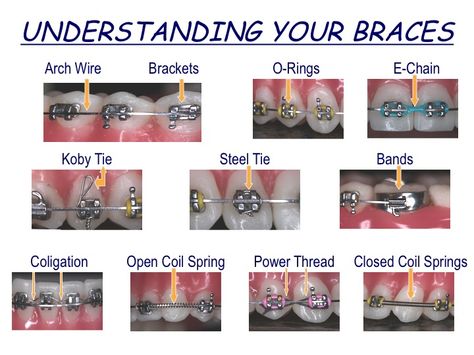 Braces vocabulary and diagram.  This could be very helpful Orthodontics Memes, Braces Memes Humor, Orthodontics Assistant, Braces Meme, Braces Hacks, Braces For Teeth, Orthodontist Assistant, Braces Problems, Braces Humor