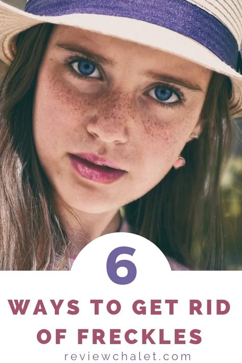 How To Get Rid Of Freckles How To Get Rid Of Freckles Naturally, How To Get Rid Of Freckles, Freckles On Hands, Freckles On Arms, How To Get Freckles, Sun Freckles, Dark Freckles, Getting Rid Of Freckles, Freckle Remover