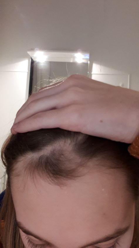 Due to bullying years ago I have a bald spot. It's growing back but I can't seem to hide it though. You see the part that's still bald and the part that's growing back. What can I do to cover it up? #hair #hairstyle #hairstyles #beauty Celebrity Hair Colors, Bald Spot, Women Makeup, Hair And Beauty, What Can I Do, Celebrity Hairstyles, Style Women, About Hair, Good Advice