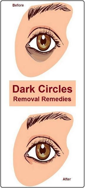 12 Simple Home Remedies to Remove Dark Circles Under Eyes Completely Baking Soda Under Eyes, Life Insurance Facts, Dark Circle Remedies, Varicose Vein Remedy, Baking Soda Face, Baking Soda Bath, Baking Soda And Lemon, Diy Body Scrub, Remove Dark Circles