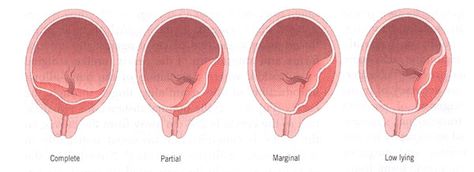 Placenta Previa. Placenta implanted in the lower uterine segment. Complete, partial, marginal and low lying. Antepartum Hemorrhage, Low Lying Placenta, Article Journal, Pregnancy Anatomy, Placenta Accreta, Preterm Baby, Traveling Pregnant, Diagnostic Medical Sonography, Ob Nursing