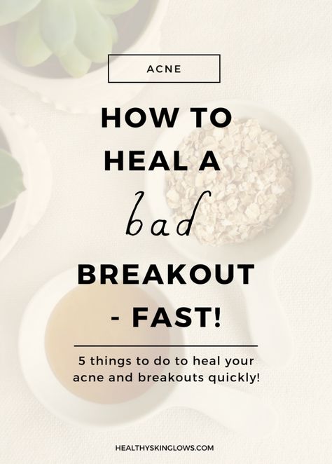 How To Heal A Bad Breakout Fast (Natural Remedies) - Healthy Skin Glows Breakout Remedies, Painful Acne, Forehead Acne, Bad Acne, Back Acne, Womens Skin Care, Acne Vulgaris, Tips For Acne, Natural Acne Remedies