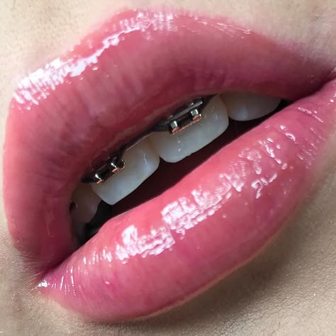 #braces #girlswithbraces #metalbraces #powerchain Lips With Braces, Girls With Braces, Gloss Lips, Braces Girls, Pink Obsession, Metal Braces, Lip Swatches, Glossy Lips, Dental Health