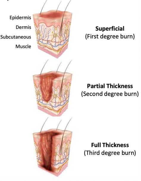 Burns are characterized, based on the depth of tissue damage and skin response, as superficial (first degree), partial thickness (second degree), or full-thickness (third-degree). Superficial burns result in only minor tissue damage to the... Nursing Burns, Burns On Skin, First Degree Burn, Second Degree Burn, Third Degree Burn, Advanced Emt, Emt Notes, Burns Nursing, Types Of Burns